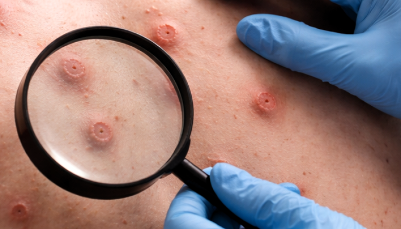 Confirman en Argentina el primer caso de mpox Clado Ib