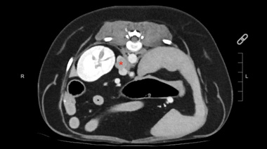 Feocromocitoma canino: un estudio revela razas y factores de riesgo