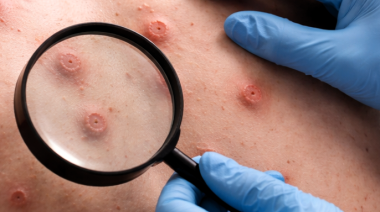 Confirman en Argentina el primer caso de mpox Clado Ib