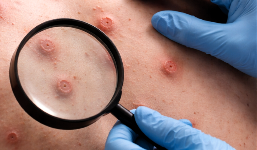 Confirman en Argentina el primer caso de mpox Clado Ib